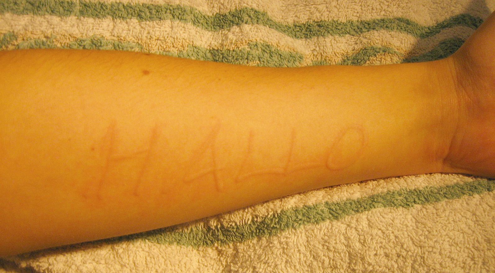 Tätowieren bei Urticaria facititia (Dermographismus)? Tattoo