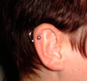 keloid_ohr.jpg