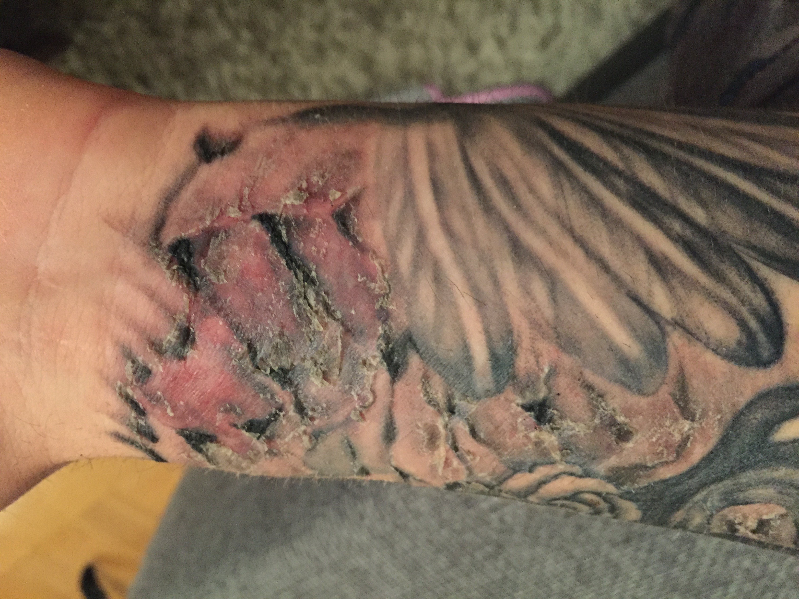 Entzündetes Tattoo Tattoopflege • Tattooscout Forum