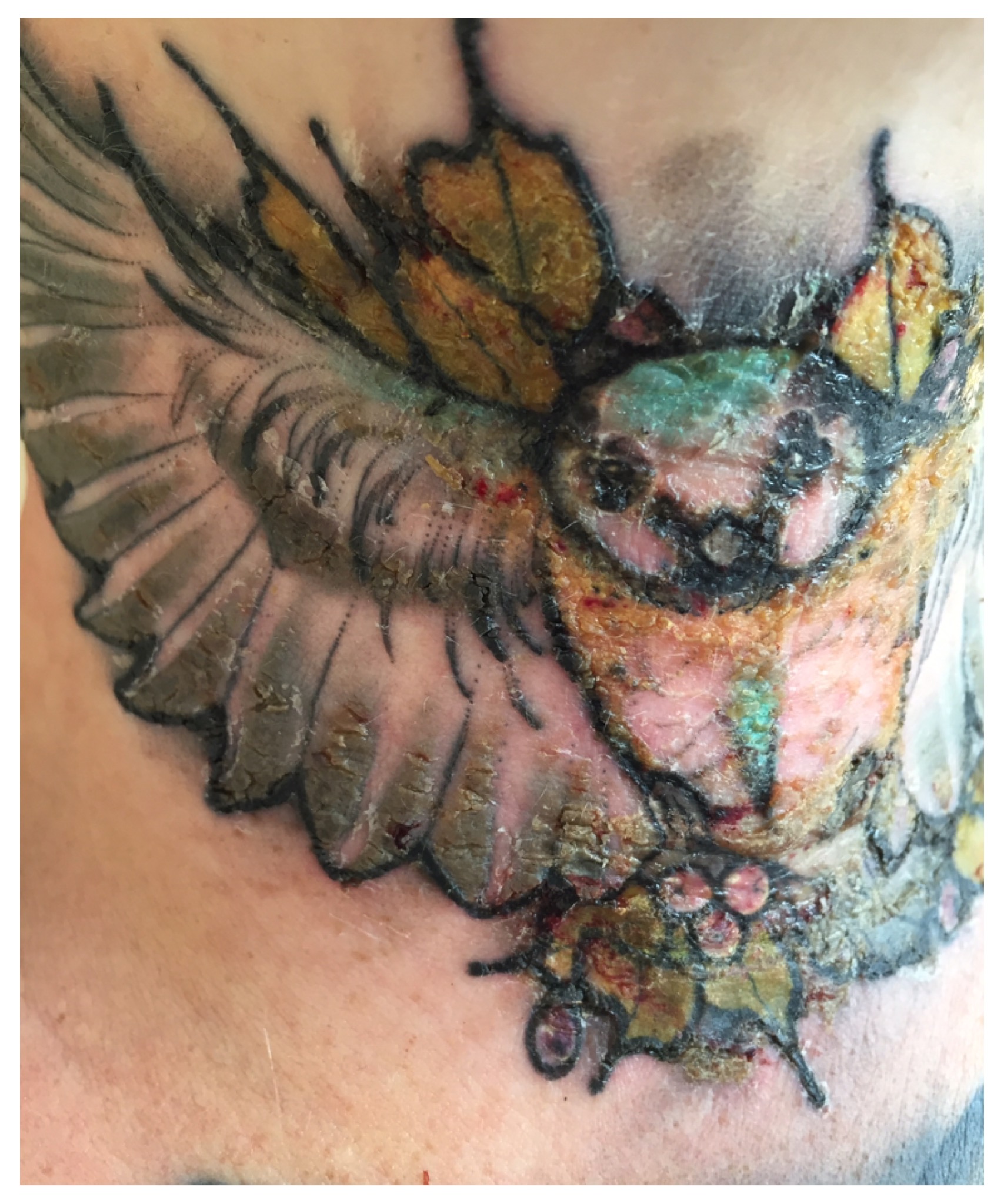 Tattoo am Hals verheilt schlecht und ist entzündet Tattoopflege