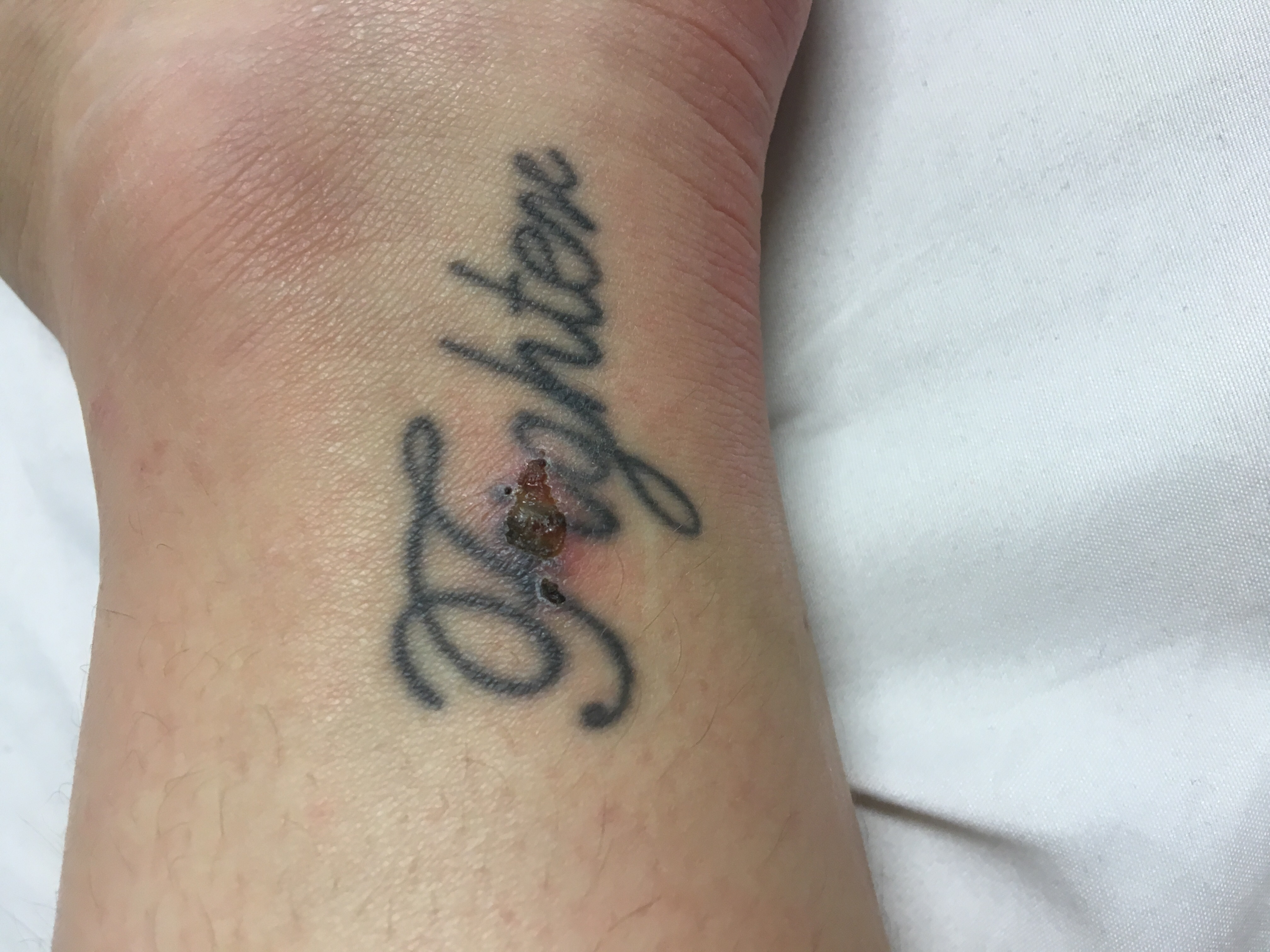 Hilfe! Wunde im tattoo Tattoopflege • Tattooscout Forum