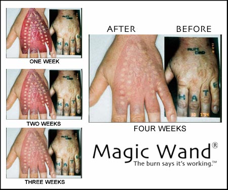 tattoo_removal_hand.jpg